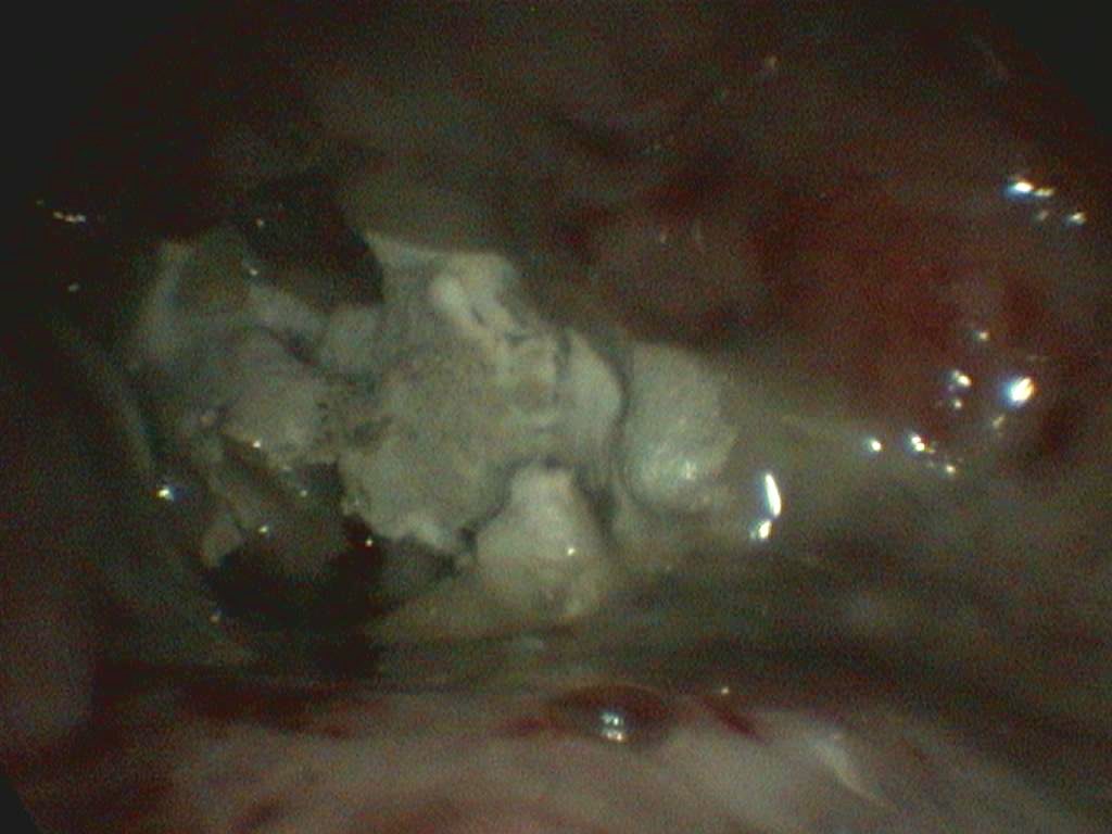 Placa micótica de Aspergillus fumigatus sobre la mucosa nasal de un perro con destrucción grave de los cornetes. Fotografía cortesía de Laura Fresno. Endolap Veterinaria©